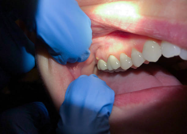 Best Emergency Treatment for Toothache in North Ballston Spa, NY